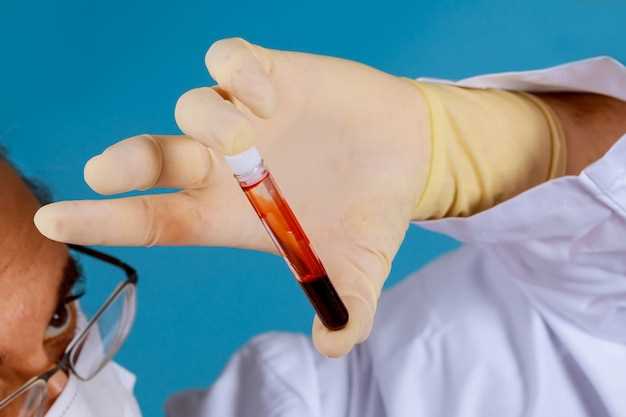 Ревматоидный фактор: значение в анализе крови у взрослых