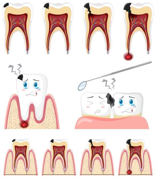 Патологические процессы на поверхности зуба