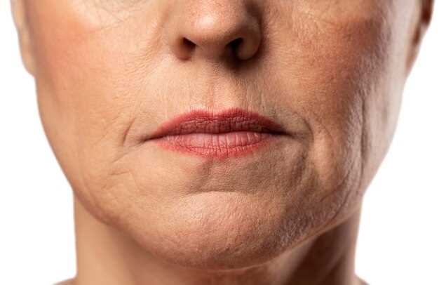 Причины и способы устранения морщин на щеках